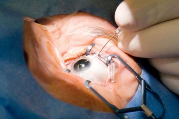 Vitreo-retinal surgery